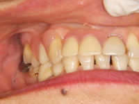 無痛義歯