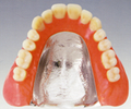コバルトクロム義歯